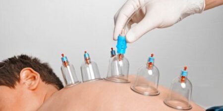 منظمة الصحة العالمية تقر العلاج بالحجامة